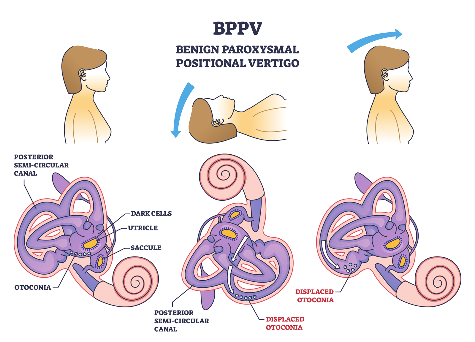 Understanding Vertigo and BPPV: Finding Relief with Solace Physio
